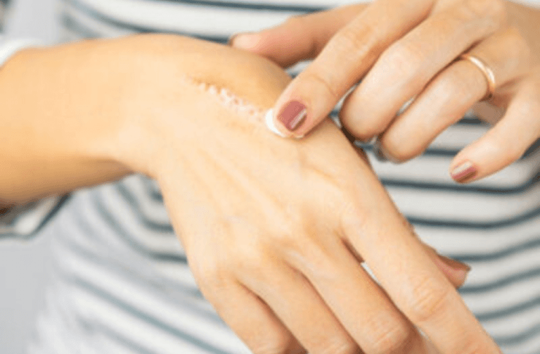 12 Effective ways to Remove Scars Fast at home